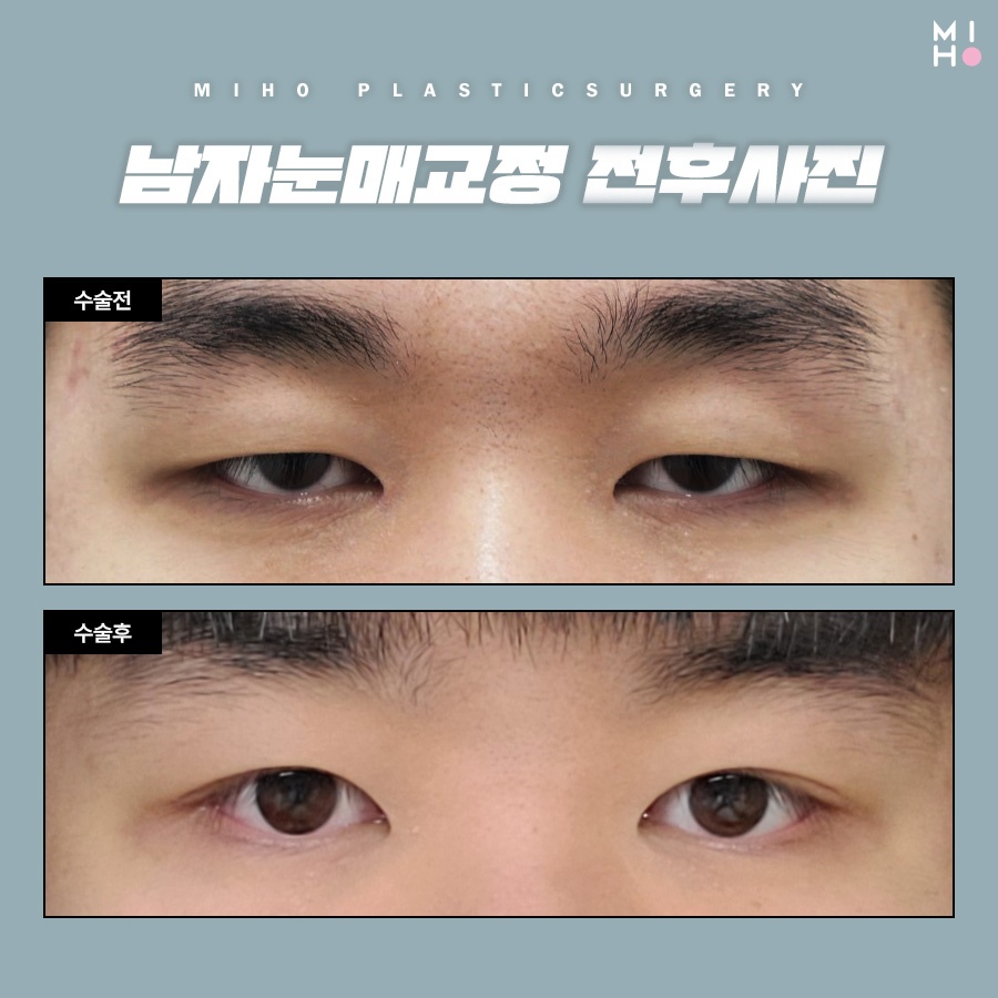 남자눈매교정 무쌍부터 유쌍까지 시원하게 관련 이미지 9