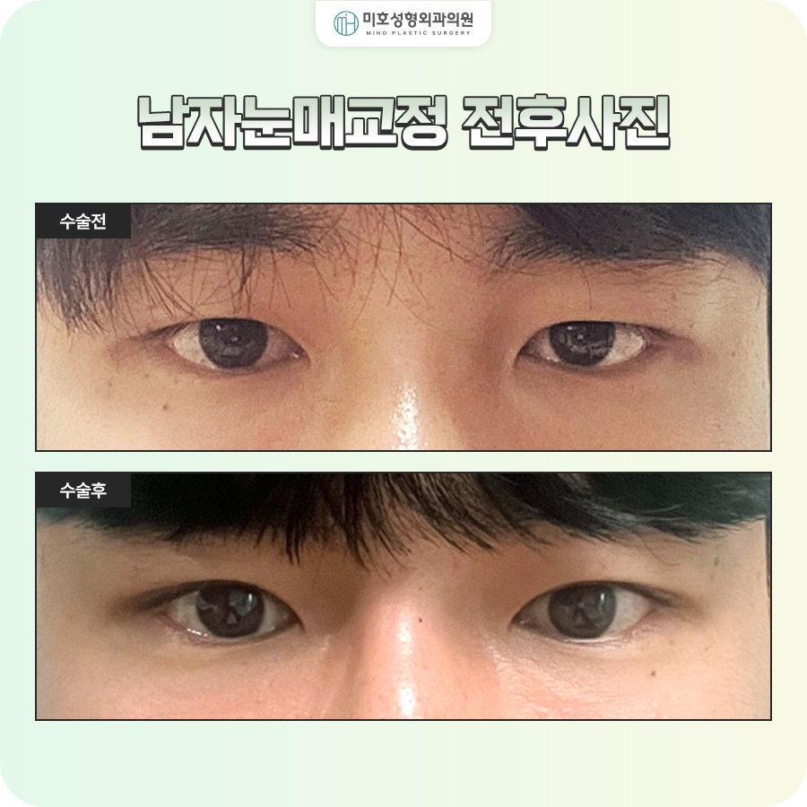 남자눈매교정 졸려 보이는 인상이 고민이라면 관련 이미지 10