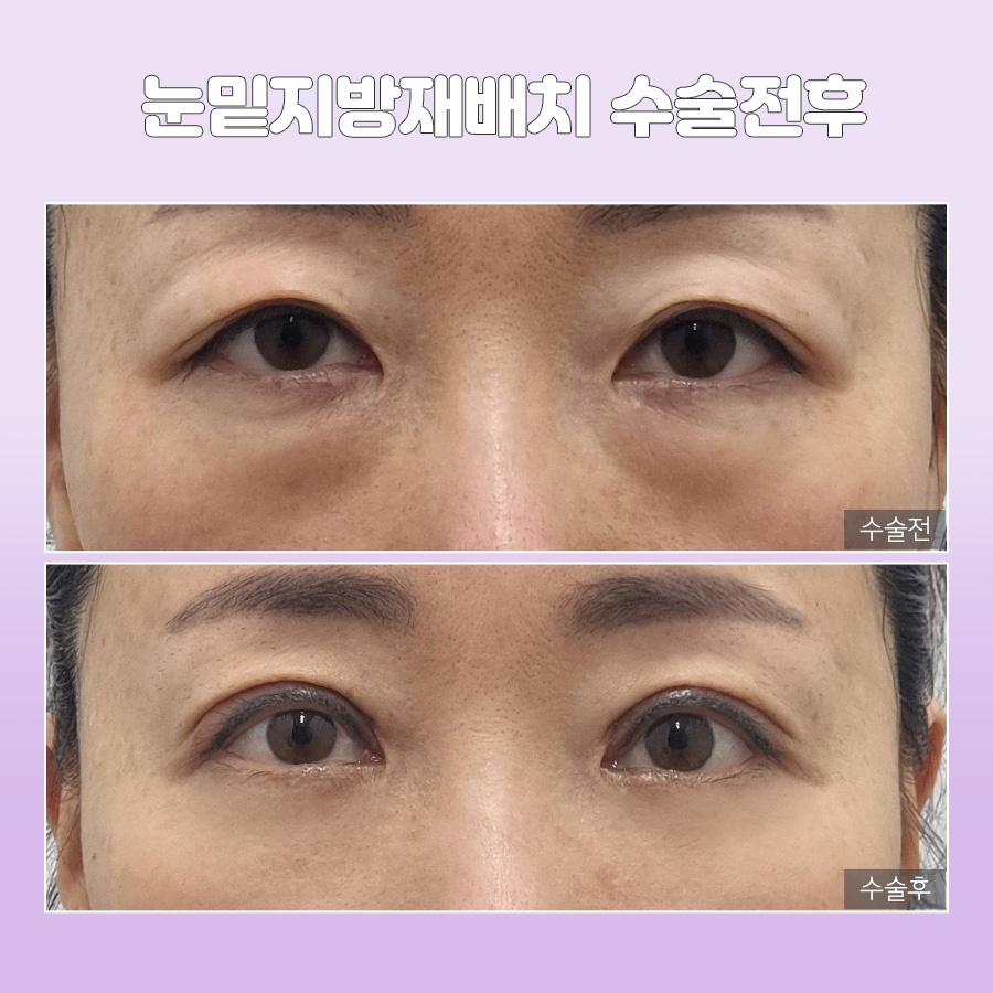 미호 시그니처 눈밑성형 지방재배치 눈매 개선 관련 이미지 8
