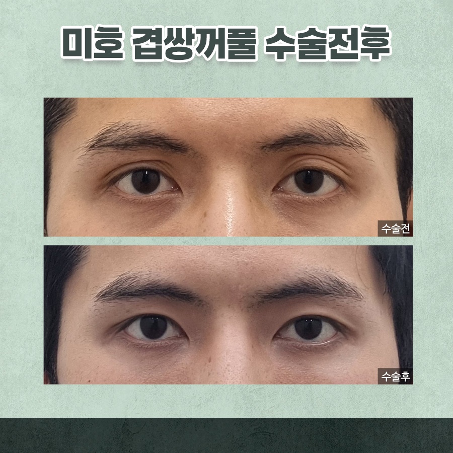 겹주름교정 자연스럽게 완성하려면 관련 이미지 9