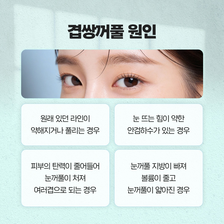 겹쌍꺼풀 생기는 이유와 없애는 방법까지 관련 이미지 3