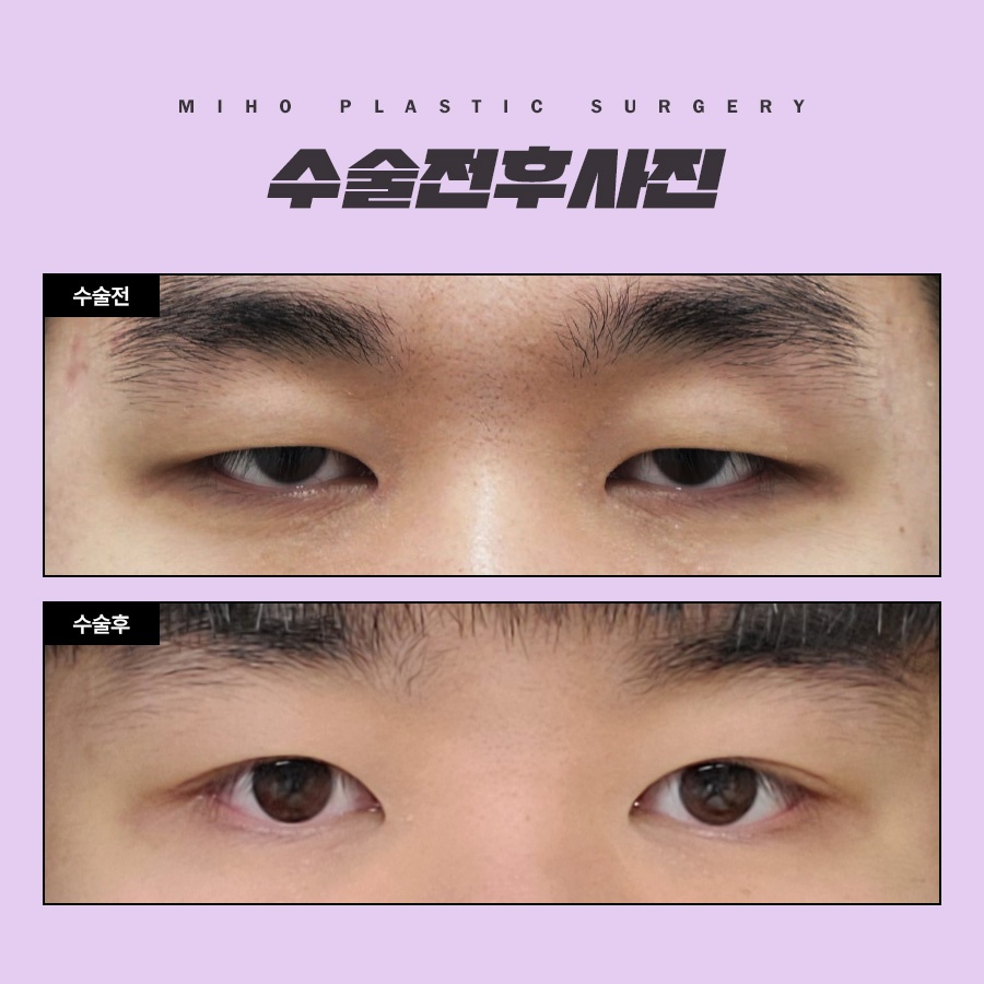 The Key to a Natural Image Transformation with Male Eyelid Surgery image 9