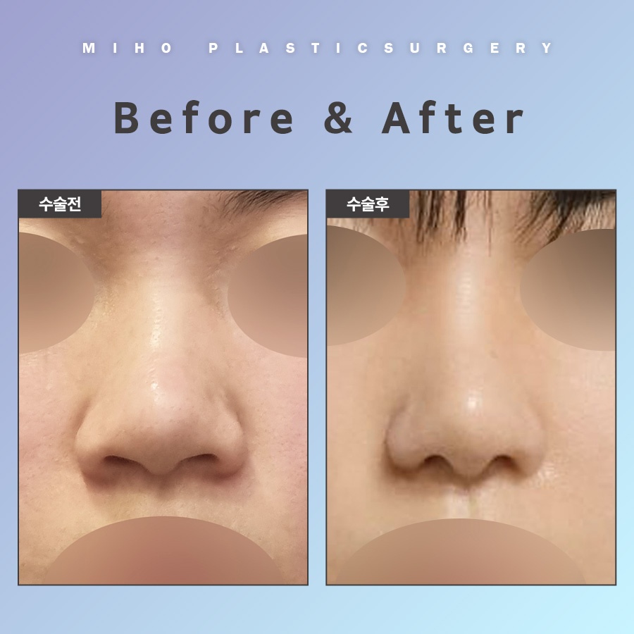 Natural-Looking Alar Reduction with Minimal Incisions image 7