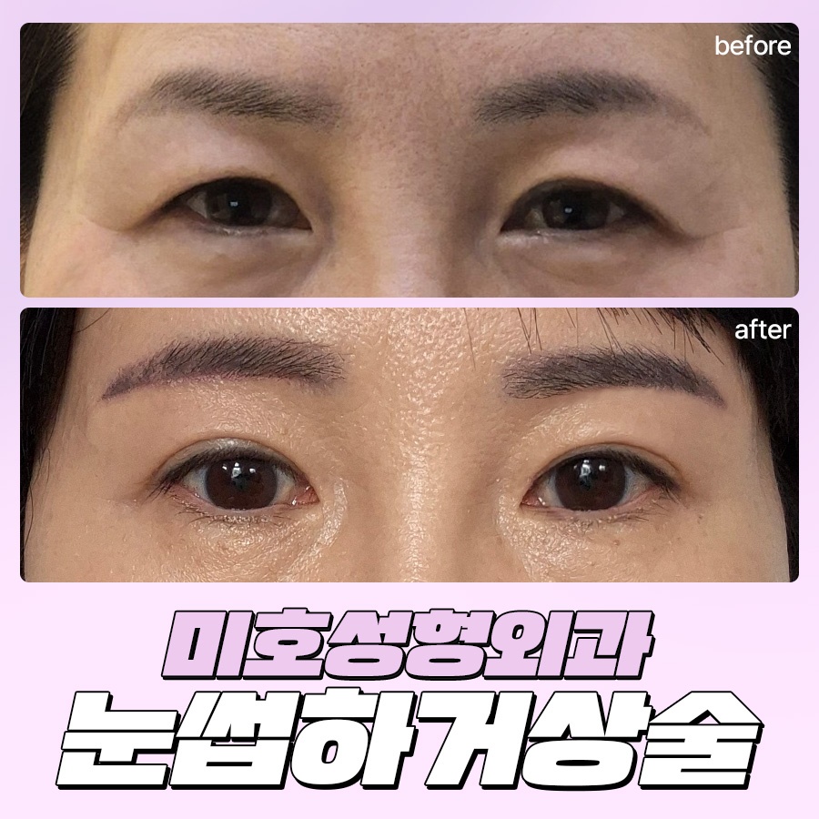 눈썹하거상술 비용과 후기 흉터 궁금하다면 관련 이미지 1