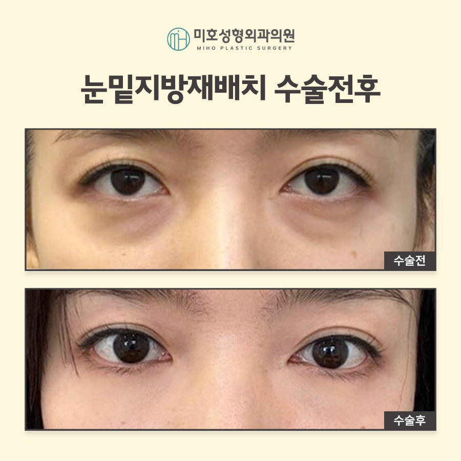 눈밑지방재배치 빠른 대처 방안 관련 이미지 8