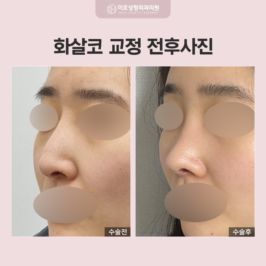 화살코 형태의 원인과 개선 방법 관련 이미지 7