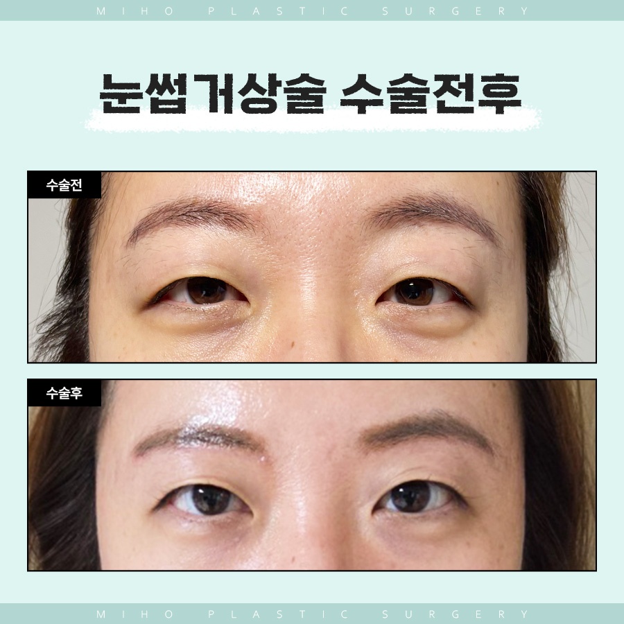 눈썹거상술 인위적이지 않은 변화 관련 이미지 9