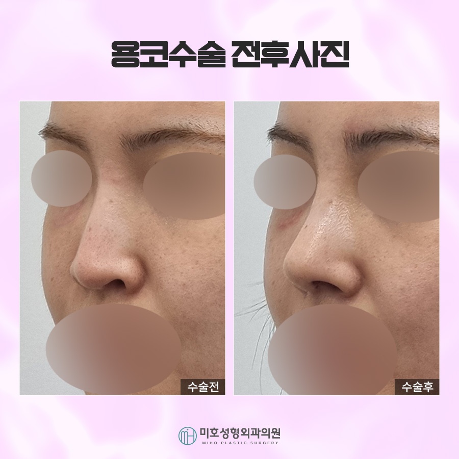 Through Drooping Nostril Correction in Bulbous Nose Surgery image 8