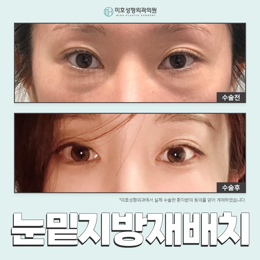 눈밑지방재배치 어두운 인상이 고민이라면 관련 이미지 1