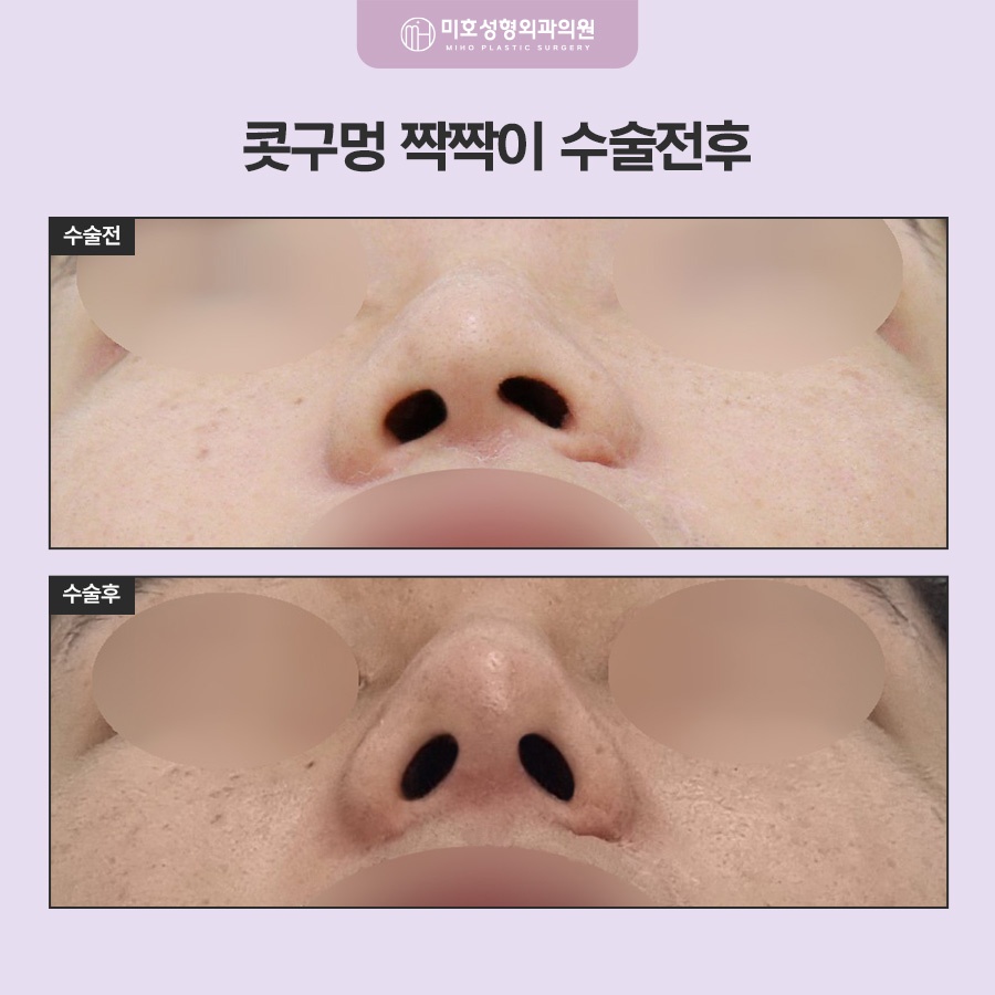 콧구멍짝짝이 원인과 교정 방향 관련 이미지 7