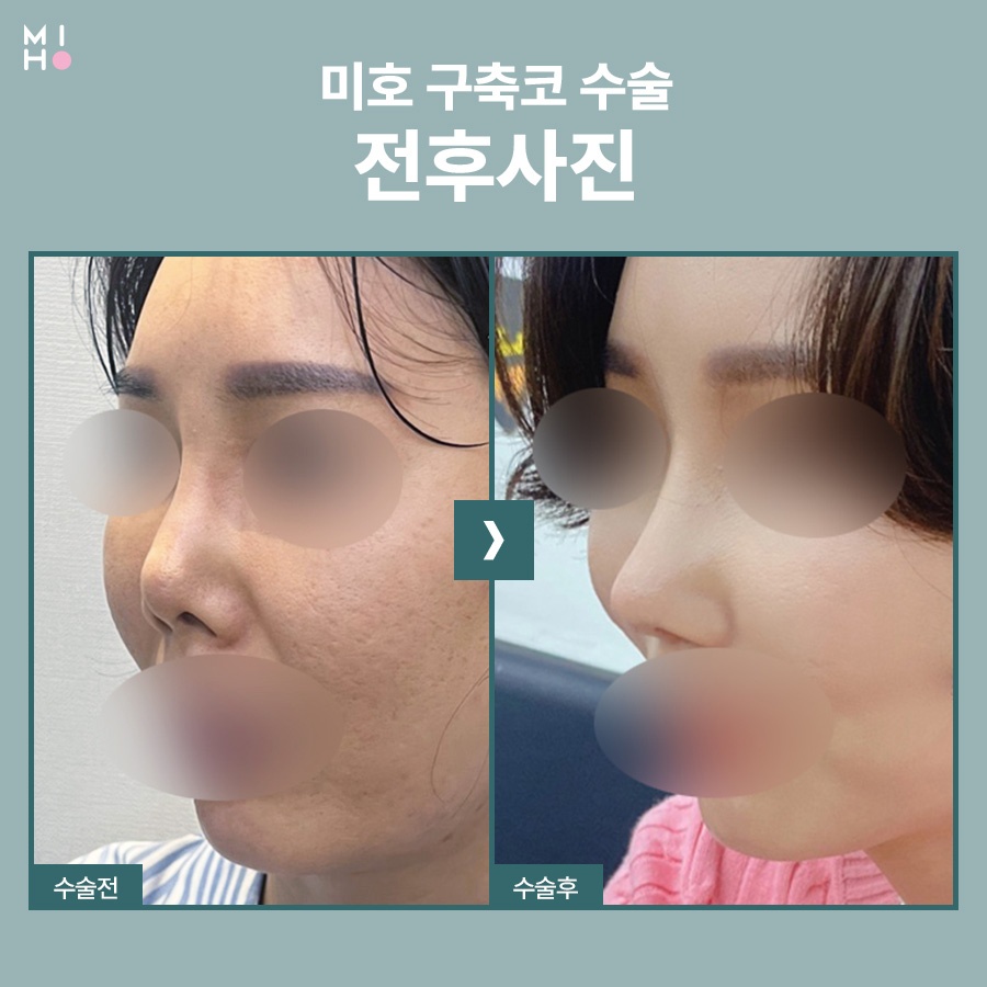 When Is Improvement for a Contracted Nose Needed? image 11