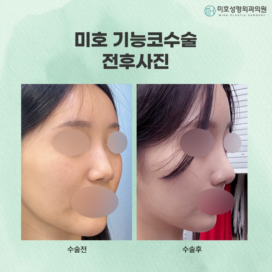 The Progression of a Deviated Nasal Septum and Precautions image 8