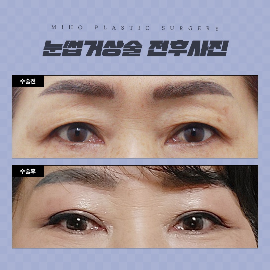 눈썹거상술 잘못된 오해와 장단점 관련 이미지 8