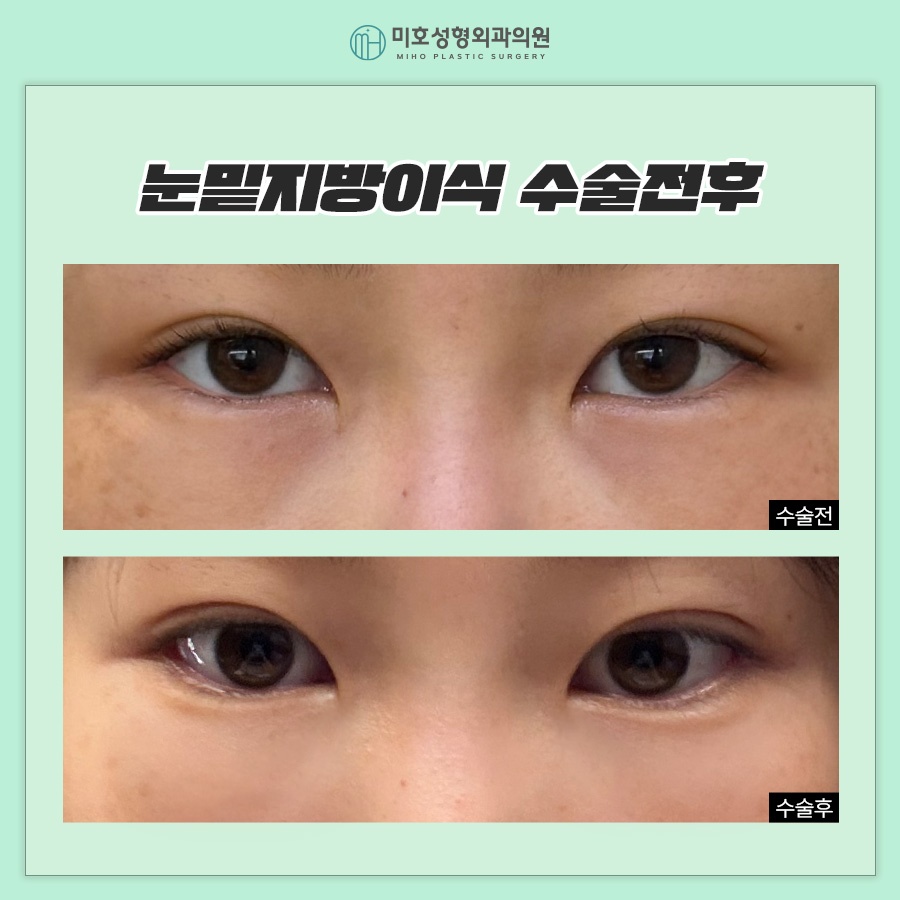 일반 눈밑지방이식과 나노지방이식의 차이점 관련 이미지 7