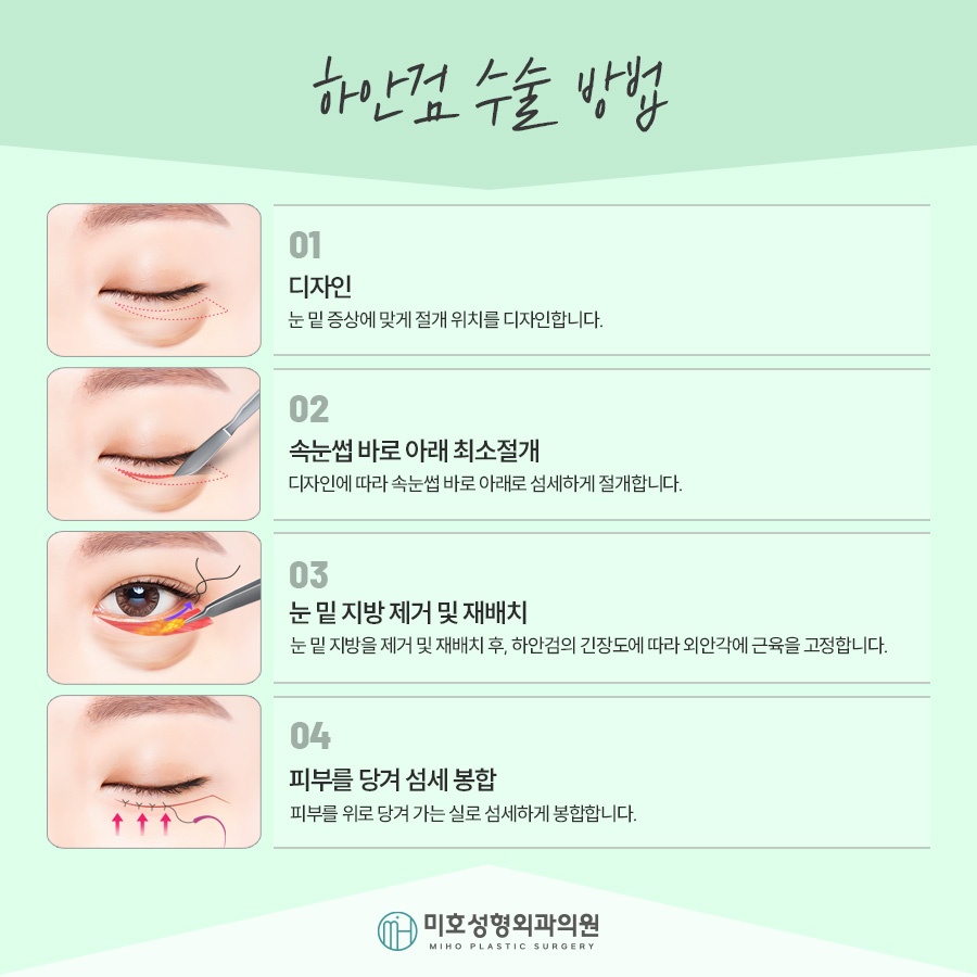 If Lower Blepharoplasty Is Needed for Drooping Eyes image 4
