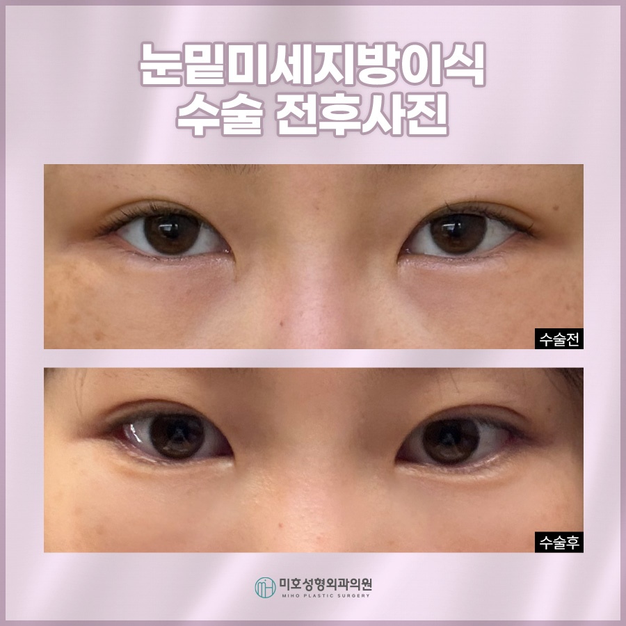 눈밑미세지방이식 올바른 계획으로 관련 이미지 8