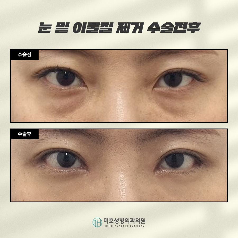 Under-Eye Fat Grafting and Filler Lumps: Addressing Side Effects Through Under-Eye Fat Repositioning and Foreign-Material Removal image 6