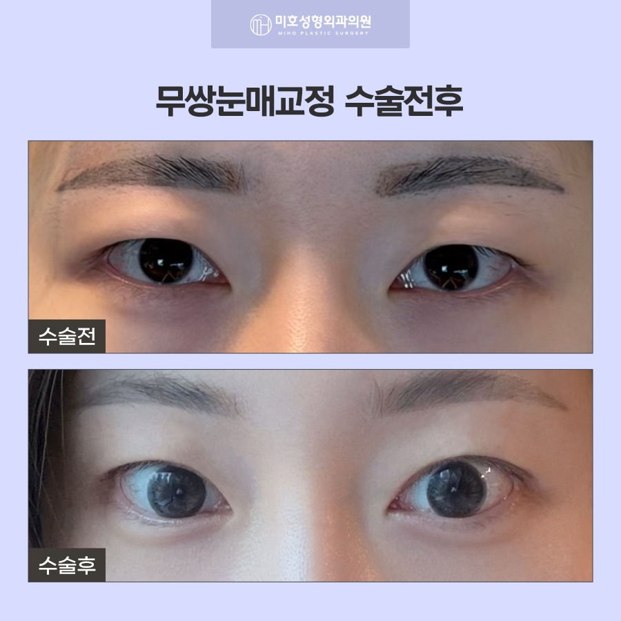 무쌍눈매교정 쌍꺼풀 없이 크고 또렷한 눈으로 관련 이미지 7