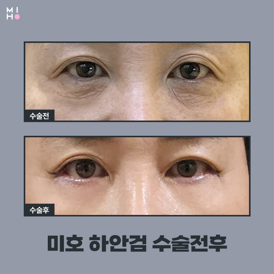 하안검수술 이미지 변신도 안전하게 관련 이미지 9