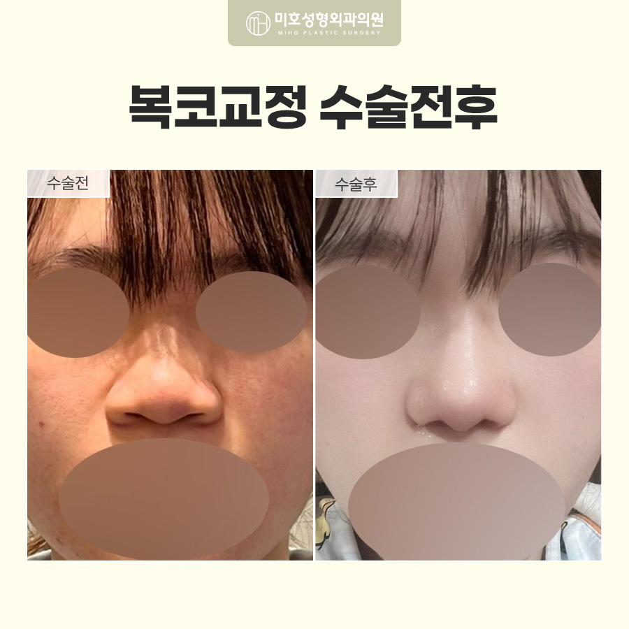 복코교정이란? 복코 원인부터 수술방법, 회복기간까지 알아보기 관련 이미지 9