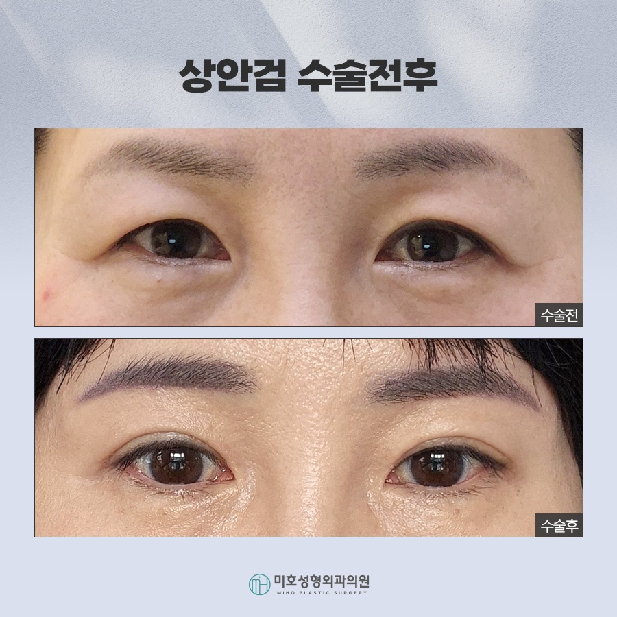 An In-Depth Analysis of Upper and Lower Blepharoplasty image 7