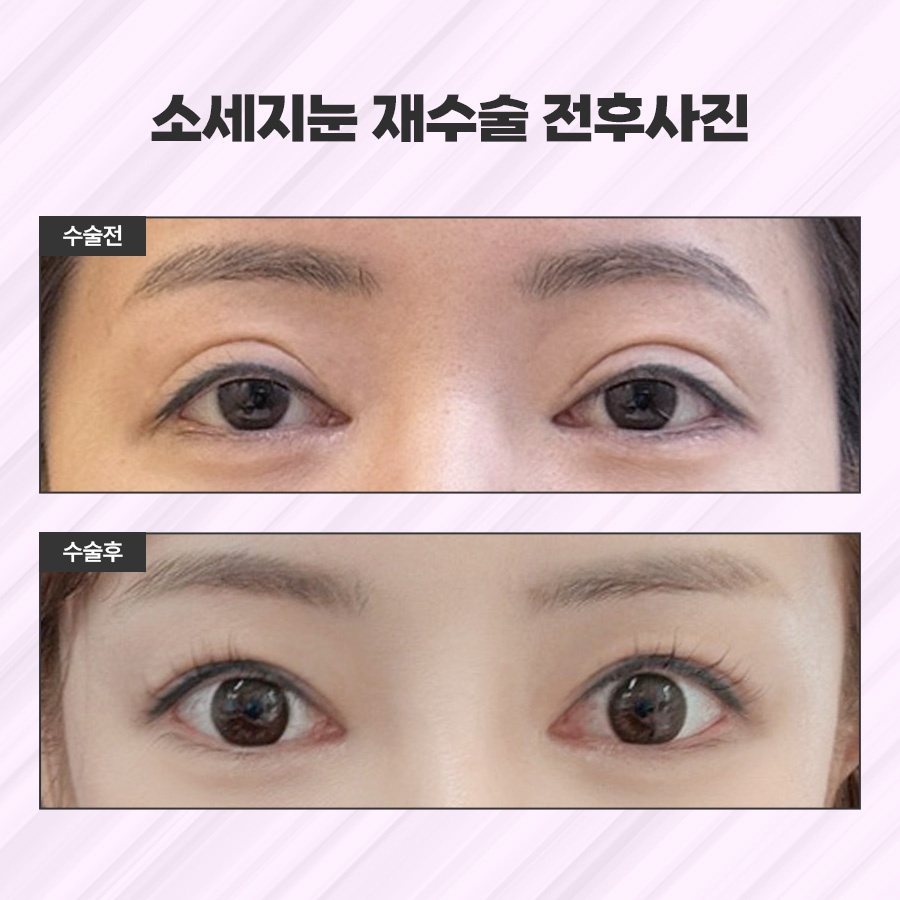 소세지눈재수술 적용 방식 2가지 관련 이미지 7