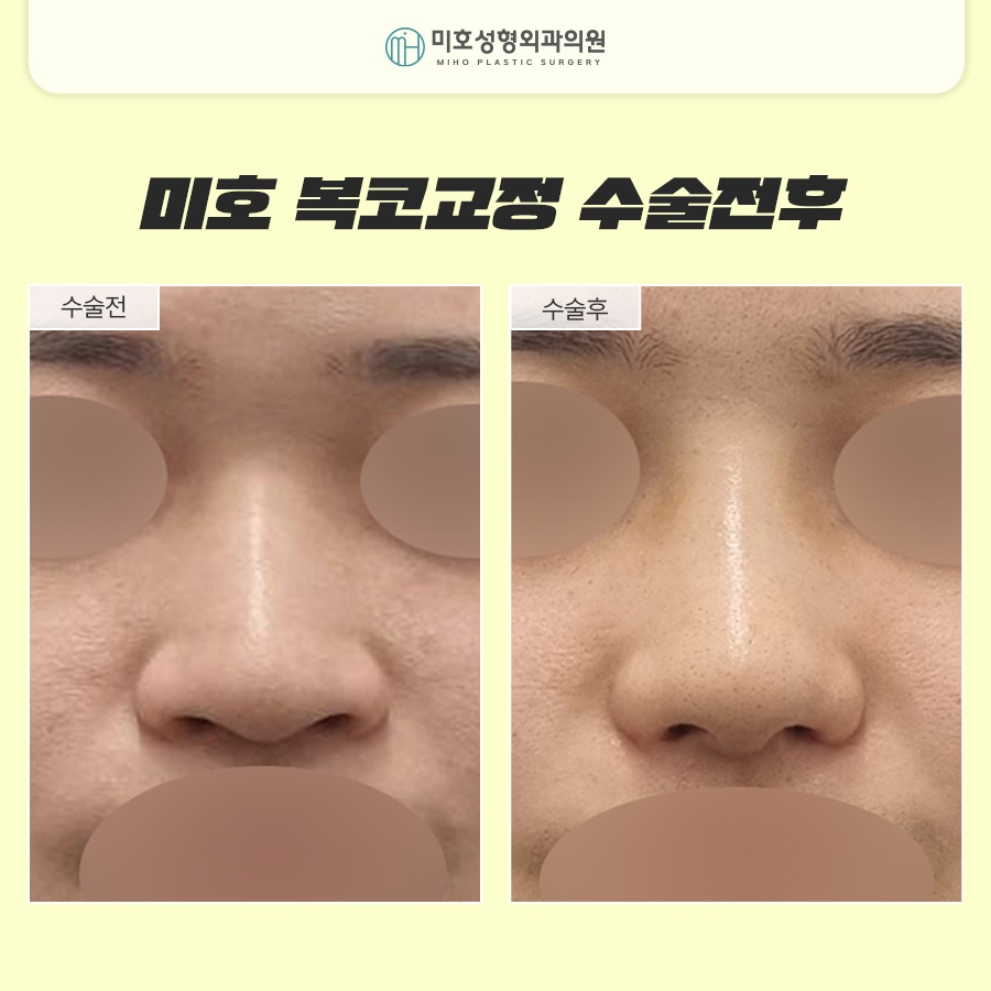 Naturally Improve the Bulbous Nose Complex image 10