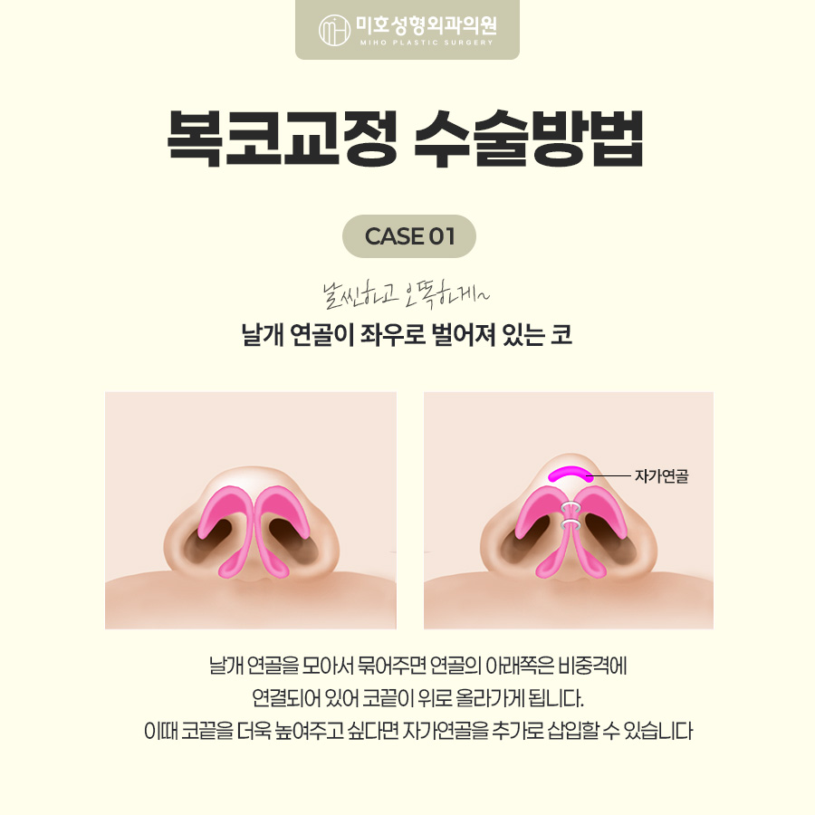 복코교정이란? 복코 원인부터 수술방법, 회복기간까지 알아보기 관련 이미지 4