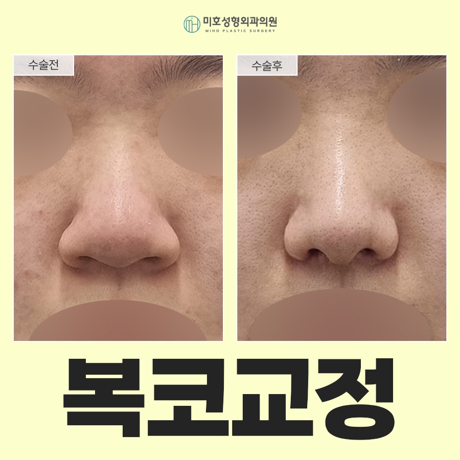 Naturally Improve the Bulbous Nose Complex image 1