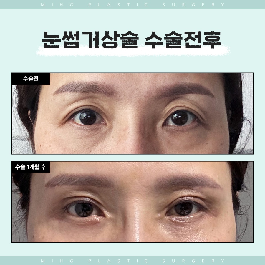 눈썹거상술 인위적이지 않은 변화 관련 이미지 6