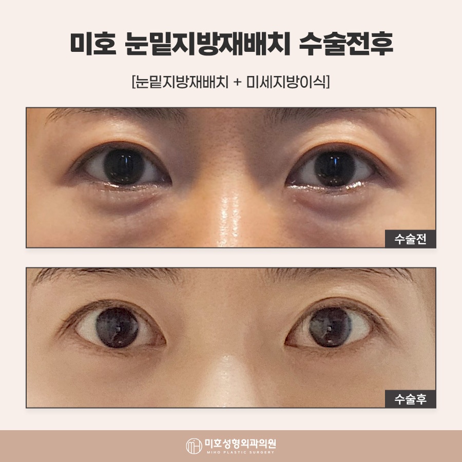 눈밑지방재배치수술후 회복 흐름 살펴봐야 관련 이미지 7