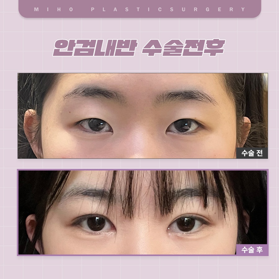 안검내반 속눈썹찔림 원인과 관리 관련 이미지 7
