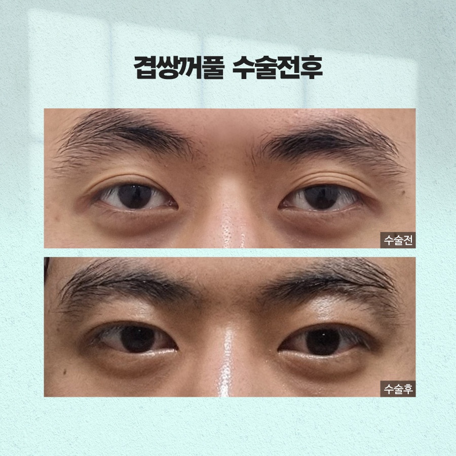 겹쌍꺼풀 생기는 이유와 없애는 방법까지 관련 이미지 10