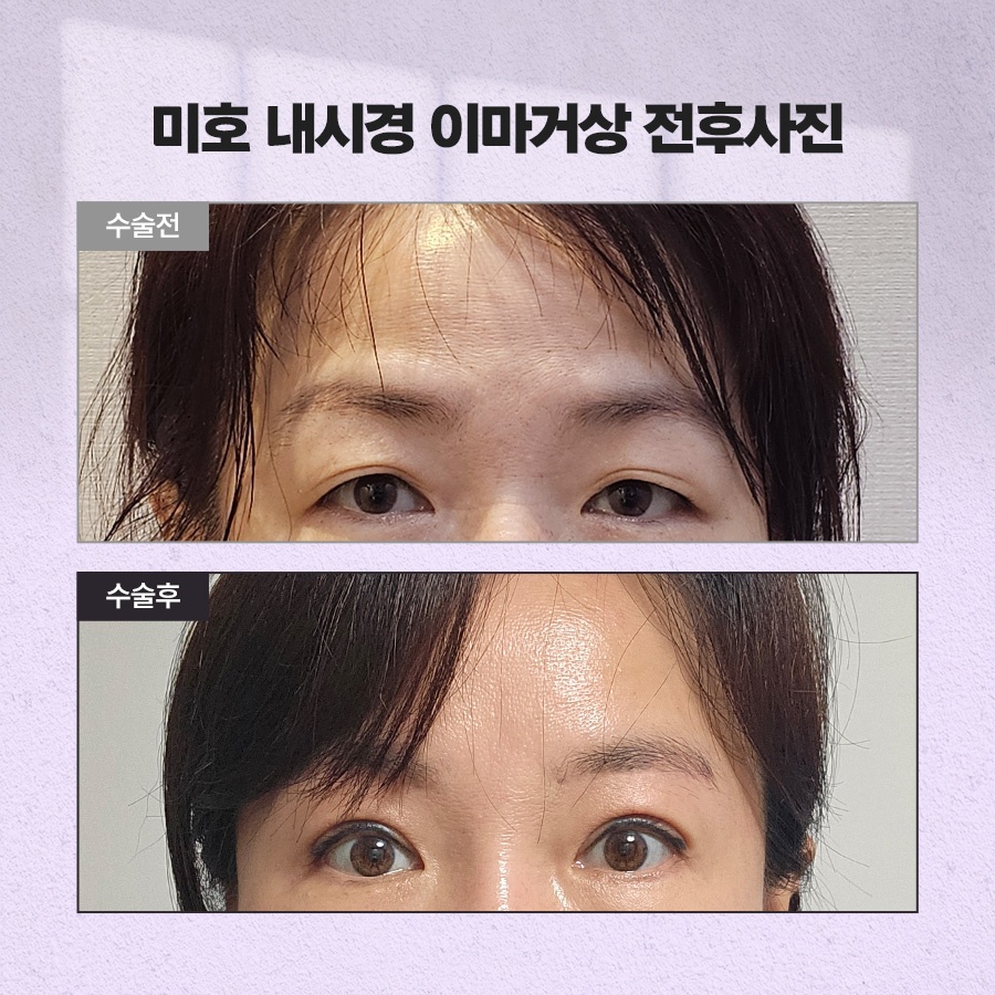 내시경이마거상 처짐 개선 원리 관련 이미지 9