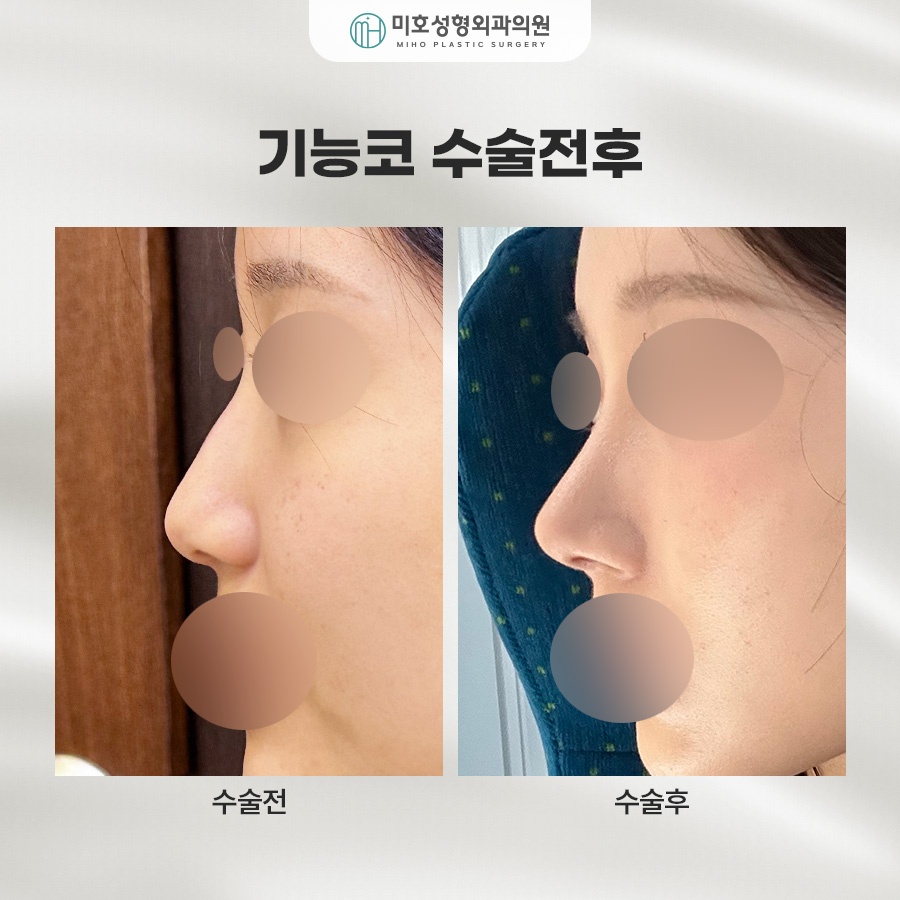 기능코 교정의 중요성 관련 이미지 9