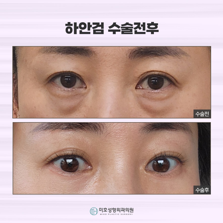 상하안검수술 처진 눈꺼풀 개선 방법 관련 이미지 9