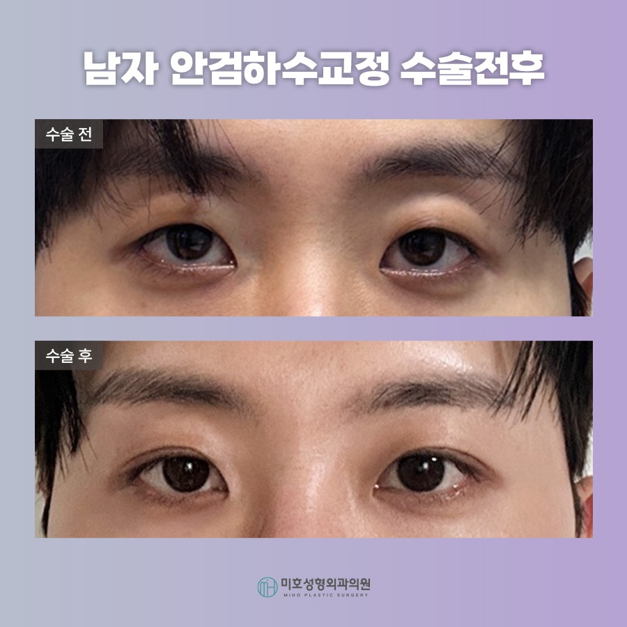 남자안검하수 자연스러움을 바탕으로 관련 이미지 9