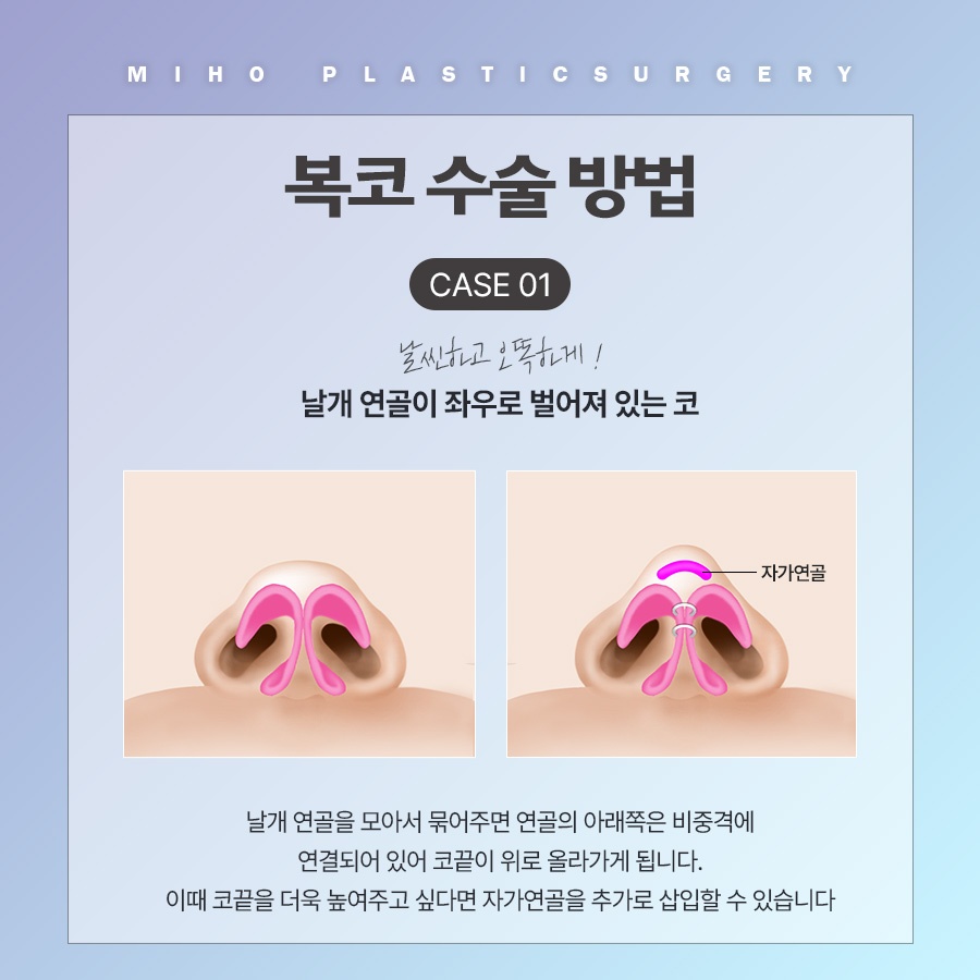 복코 교정 관상까지 좋아지려면 관련 이미지 4