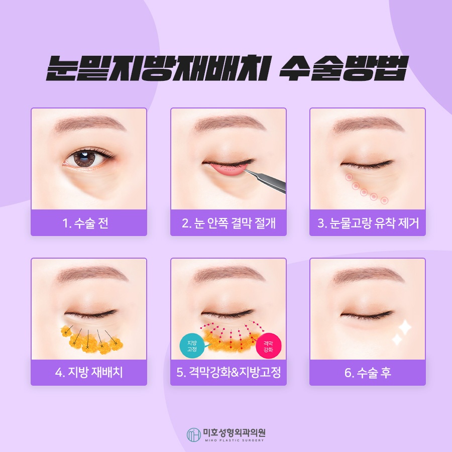 눈밑지방재배치로 젊음을 획득 관련 이미지 5
