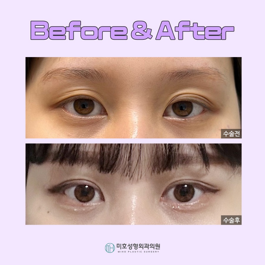 A Clean, Smooth Line for Double Eyelid Folds image 8