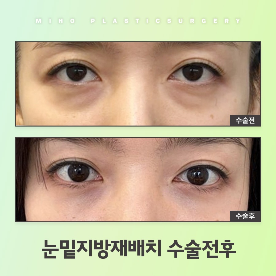 눈밑지방재배치 고민에 맞게 개선하며 관련 이미지 8