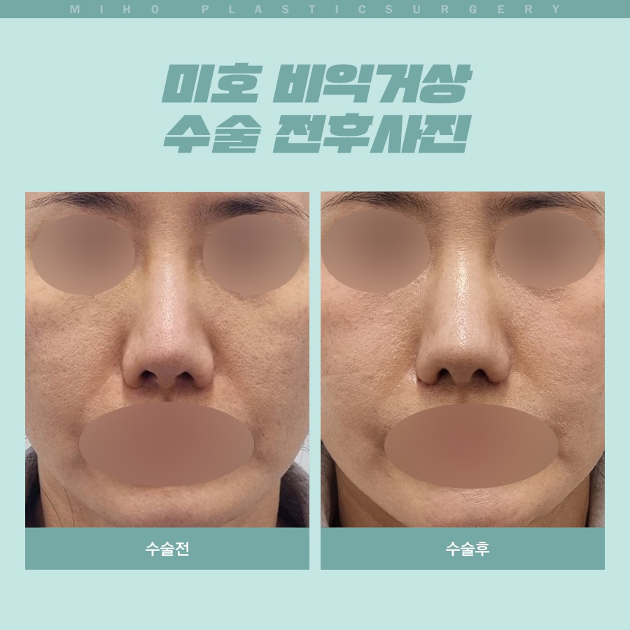 Creating a Naturally Refined Nose with an Alar Lift image 8