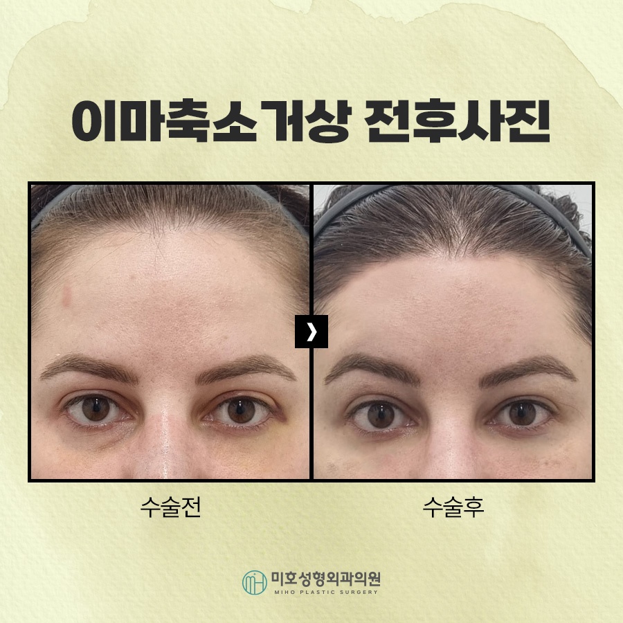 이마축소거상 부작용 더는 방법 관련 이미지 6