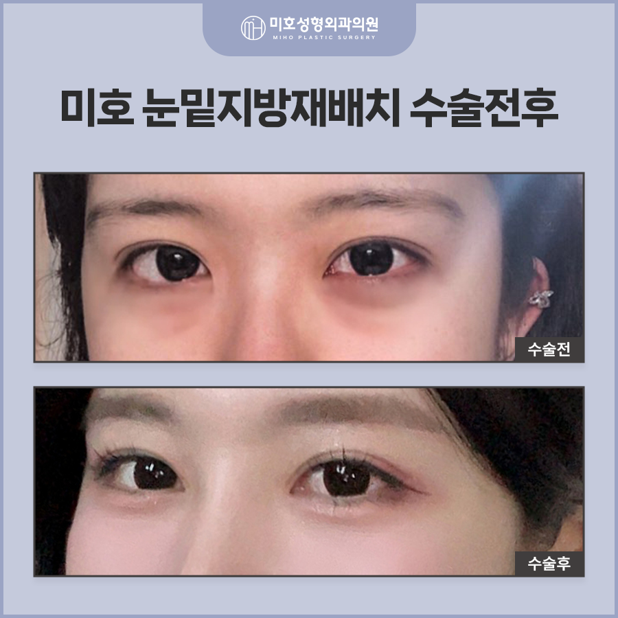 Improving Dark Circles Under the Eyes with Under-Eye Fat Repositioning to Create a More Vibrant Eye Area image 9