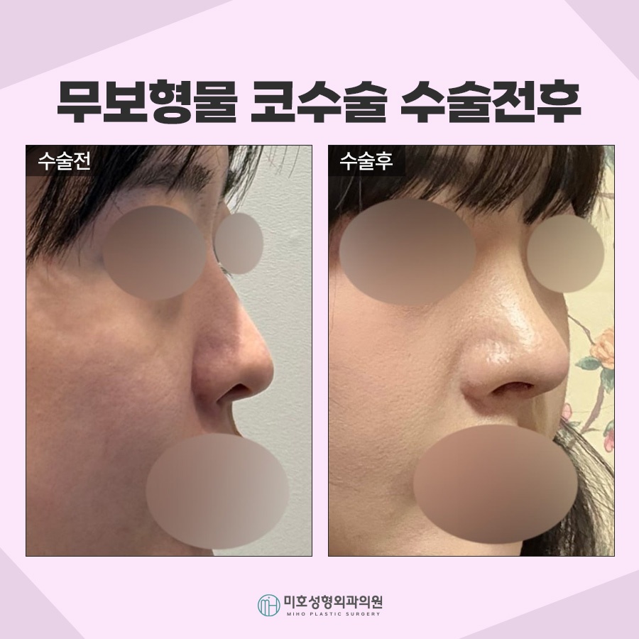 무보형물코수술 자연스러운 라인을 원한다면 관련 이미지 8
