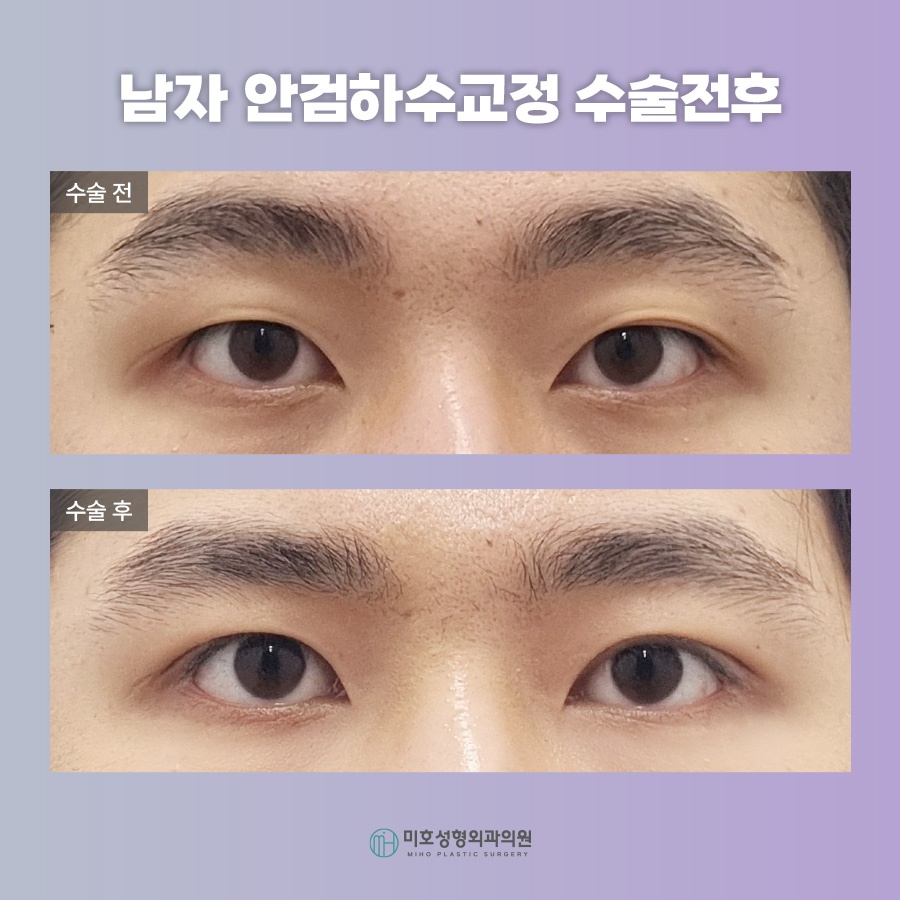 남자안검하수 자연스러움을 바탕으로 관련 이미지 8