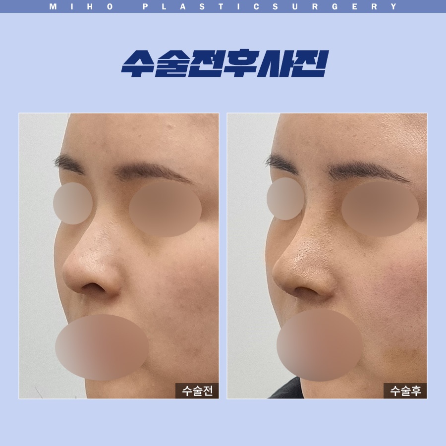 Correcting a Dragon Nose with Nostril-Lowering Surgery image 7