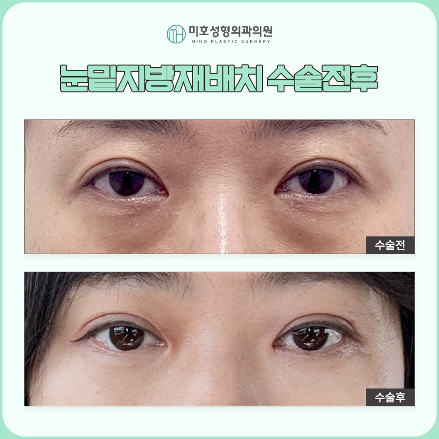 눈밑지 후기보다 의료진 실력이 중요 관련 이미지 10