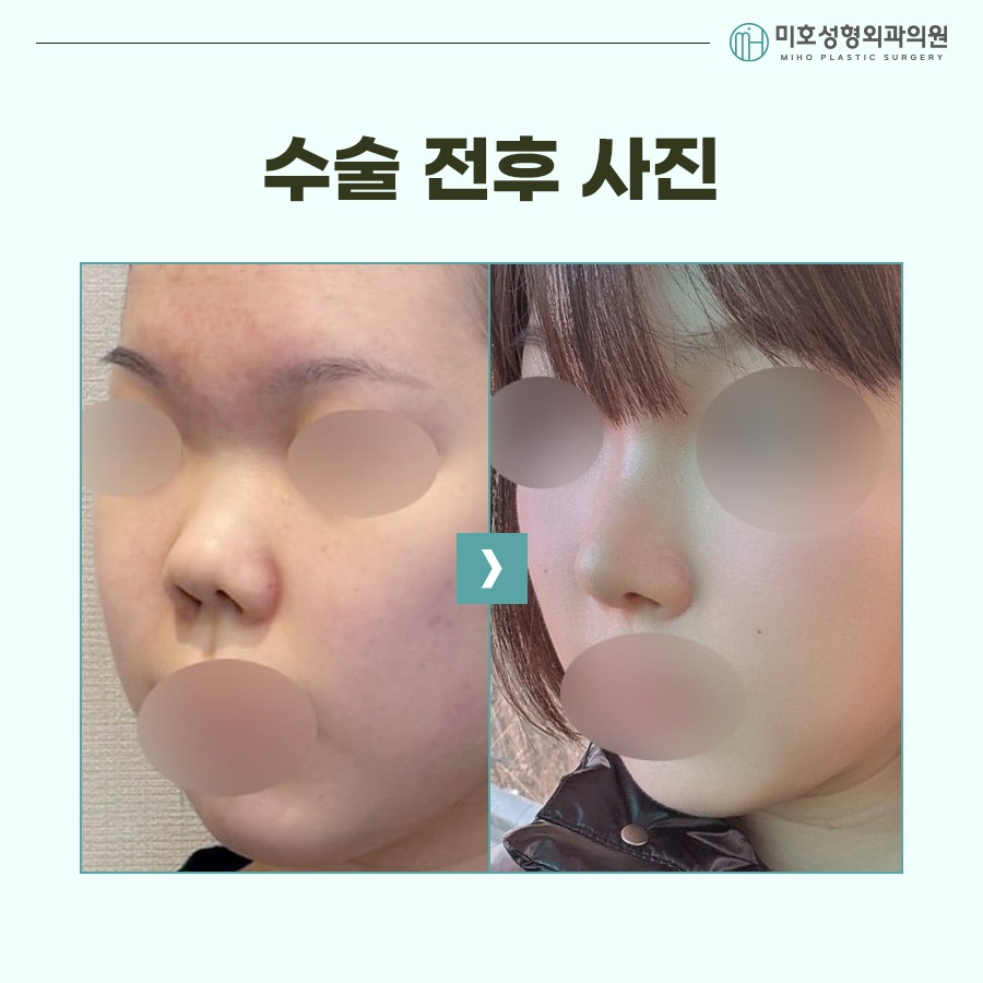 Natural Correction of an Upturned Nose image 6