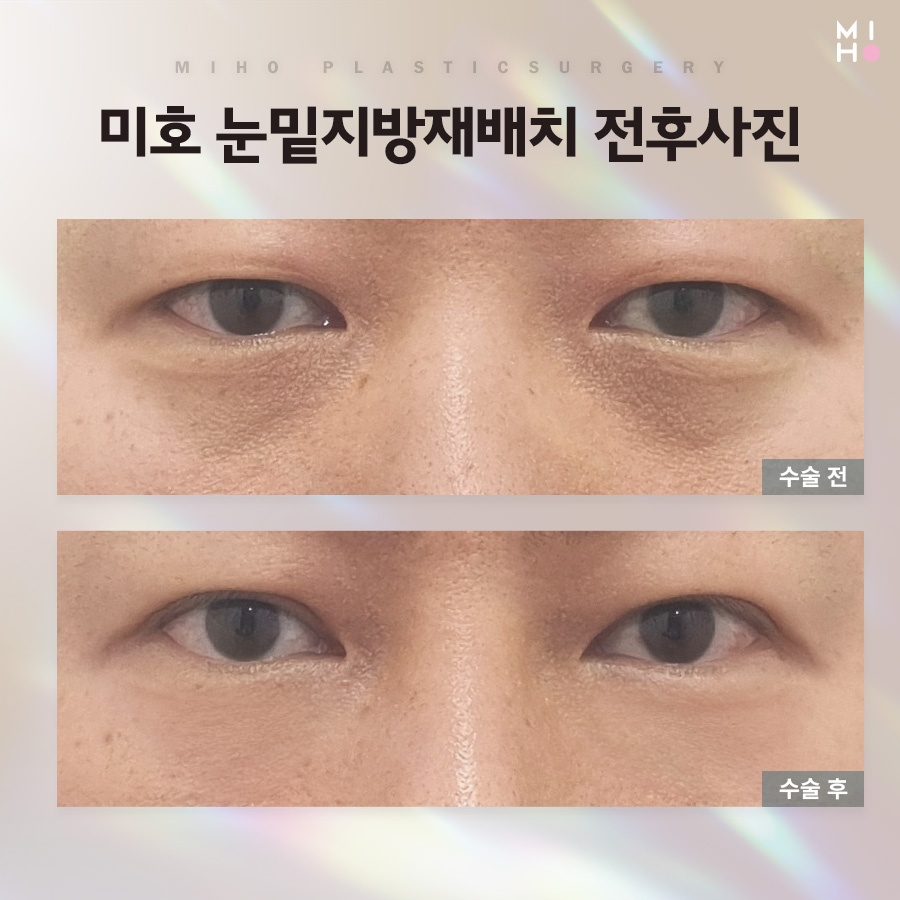 눈밑꺼짐 원인에 맞게 관련 이미지 9